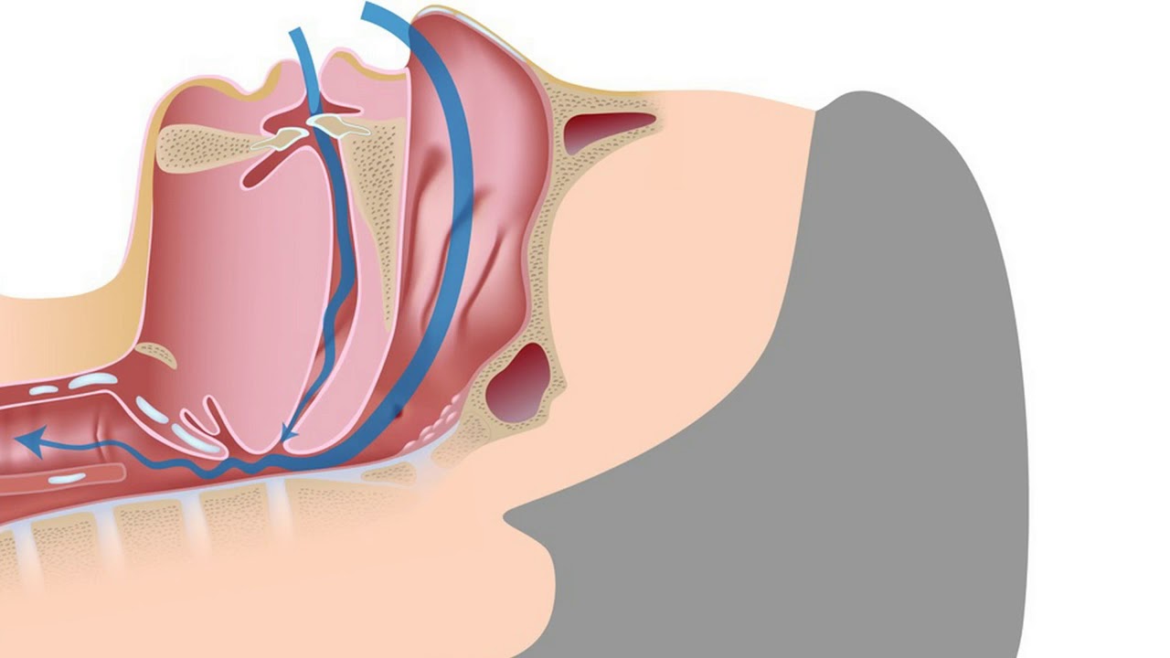 Obstruktive Schlafapnoe Syndrom OSAS Ursachen Folgen